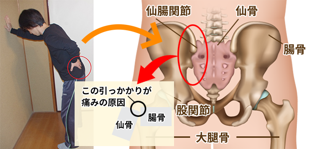 仙腸関節のロックと痛みの原因図解