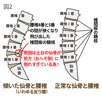 椎間板ヘルニアと仙骨の傾きの関係図