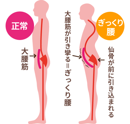 正常な姿勢とぎっくり腰の比較図解