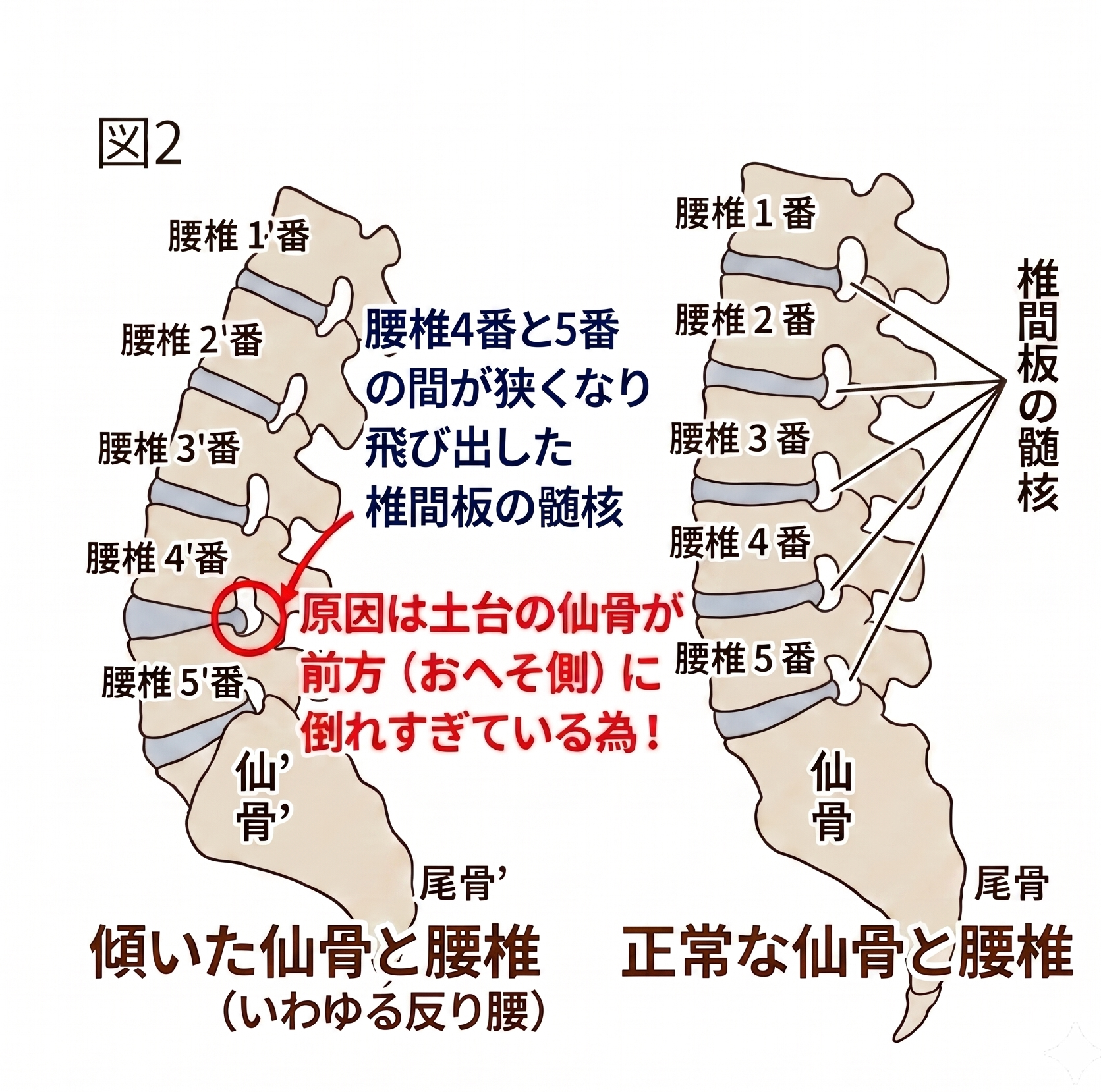 椎間板ヘルニアと仙骨の傾きの関係図