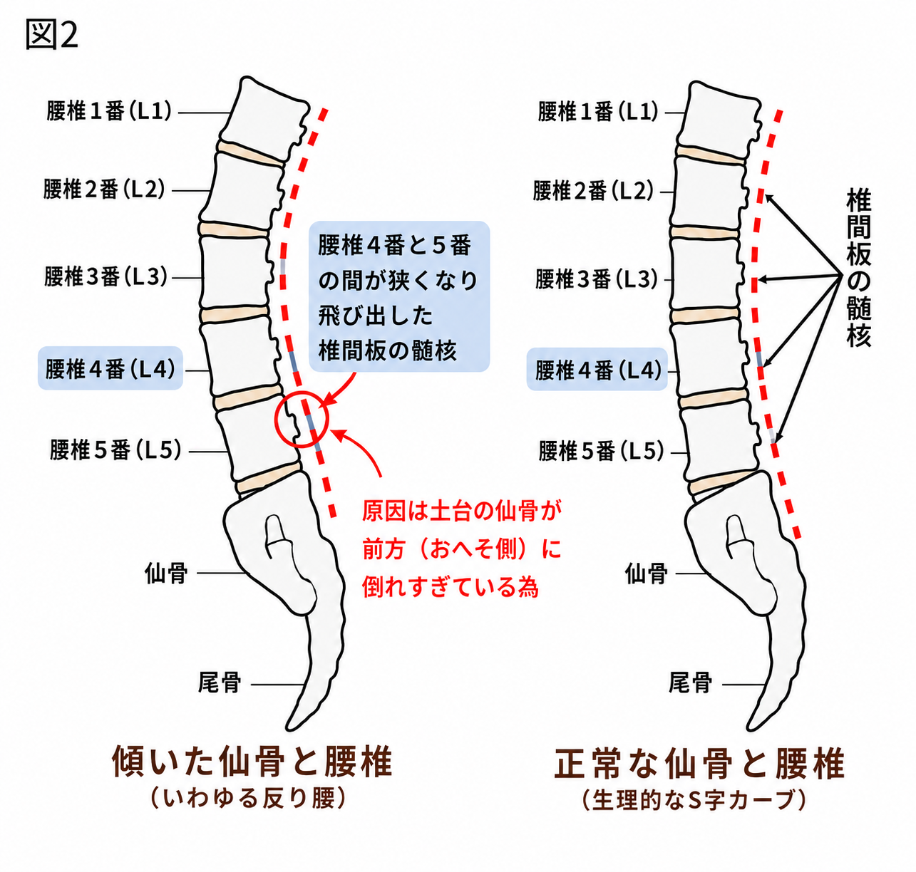 椎間板ヘルニアと仙骨の傾きの関係図